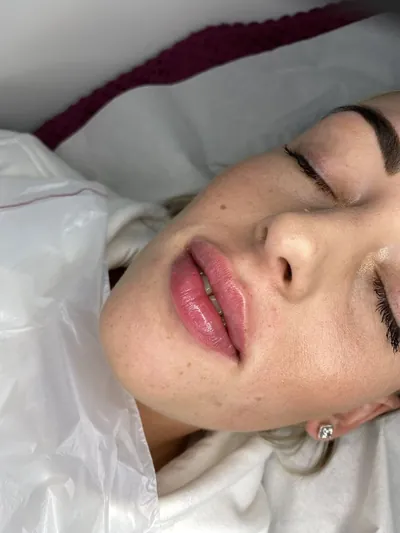 Natural lip filler result — Refined Medical Aesthetics, Whitley Bay client