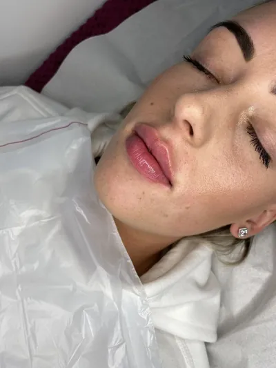 Natural lip filler result — Refined Medical Aesthetics, Whitley Bay client