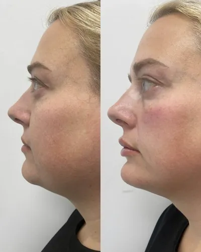 Natural lip filler result — Refined Medical Aesthetics, Whitley Bay client