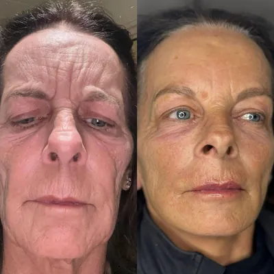 Natural lip filler result — Refined Medical Aesthetics, Whitley Bay client