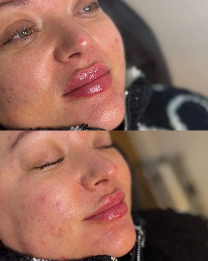 Profile balancing dermal filler result — Refined Medical Aesthetics, Whitley Bay client