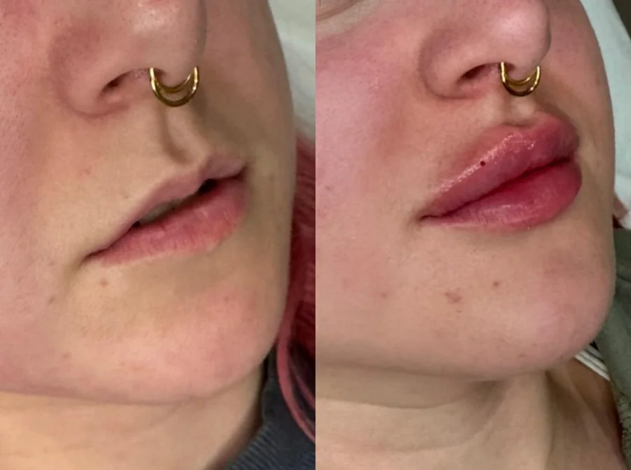 Profhilo skin quality improvement result — Refined Medical Aesthetics, Whitley Bay client