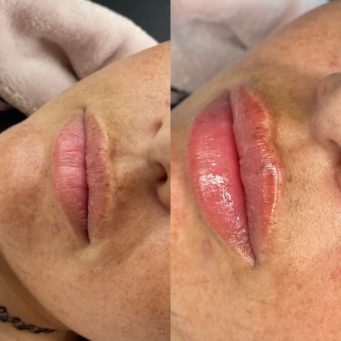 Soft lip balance at Refined Medical Aesthetics in Seaton Delaval