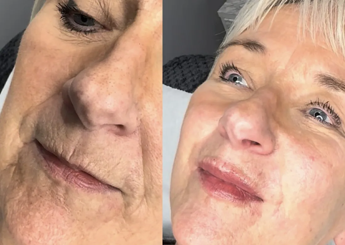 Skin freshness at Refined Medical Aesthetics in Seaton Delaval