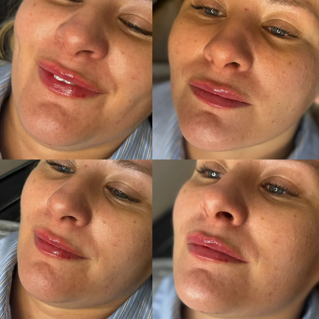 Natural lip shape at Refined Medical Aesthetics in Seaton Delaval