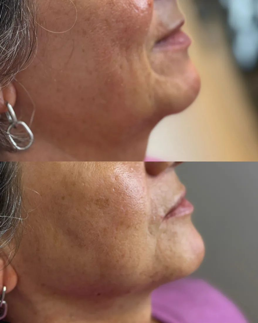 Lower face support at Refined Medical Aesthetics in Seaton Delaval