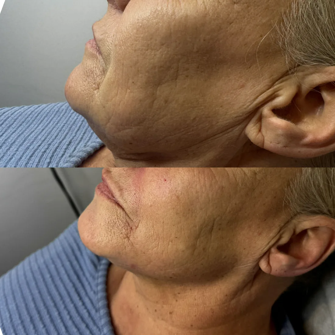 Jawline and lower face result at Refined Medical Aesthetics in Seaton Delaval