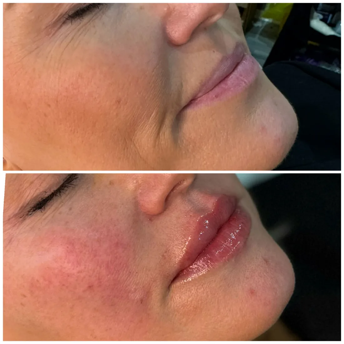 Side profile balance at Refined Medical Aesthetics in Seaton Delaval