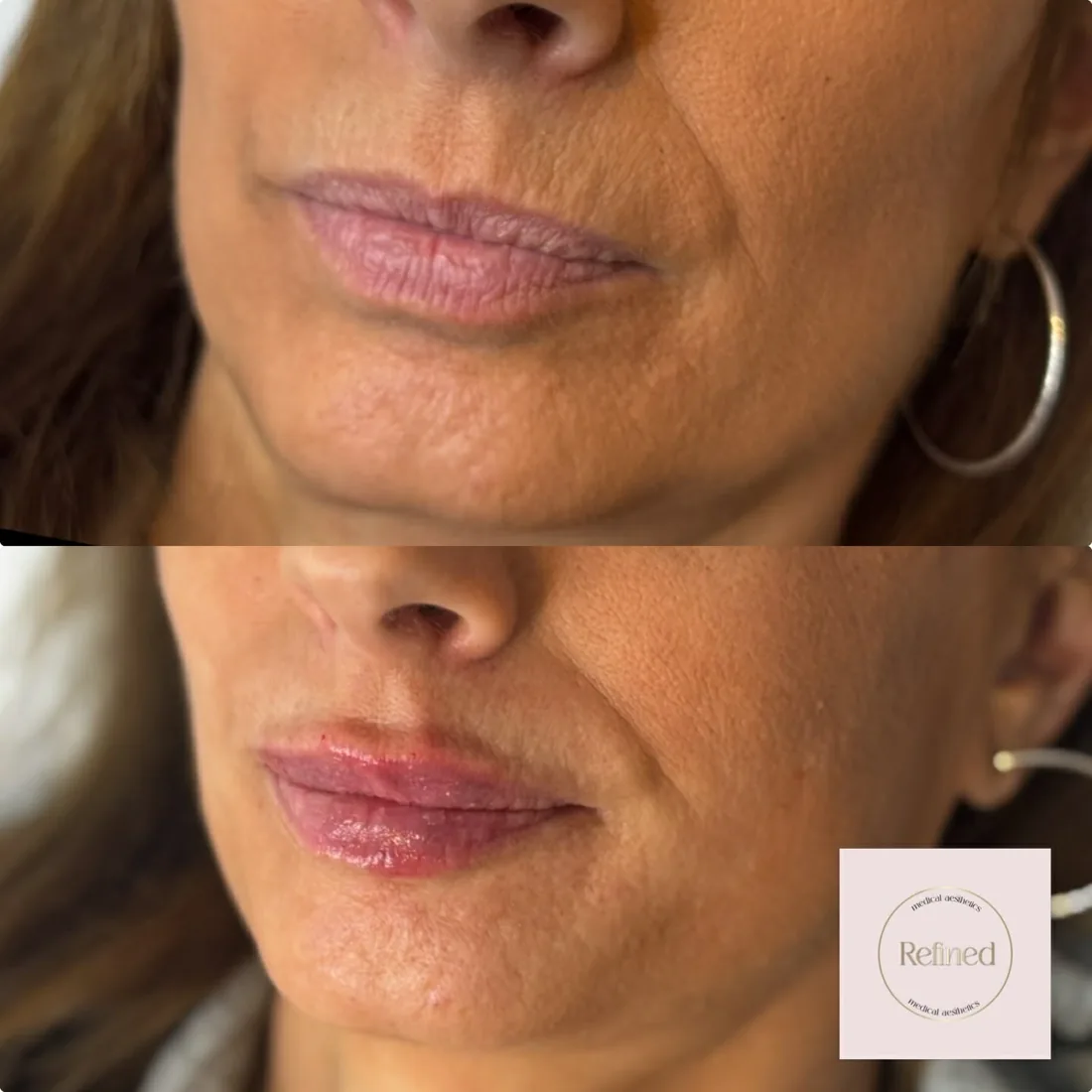 Lower face balance at Refined Medical Aesthetics in Seaton Delaval