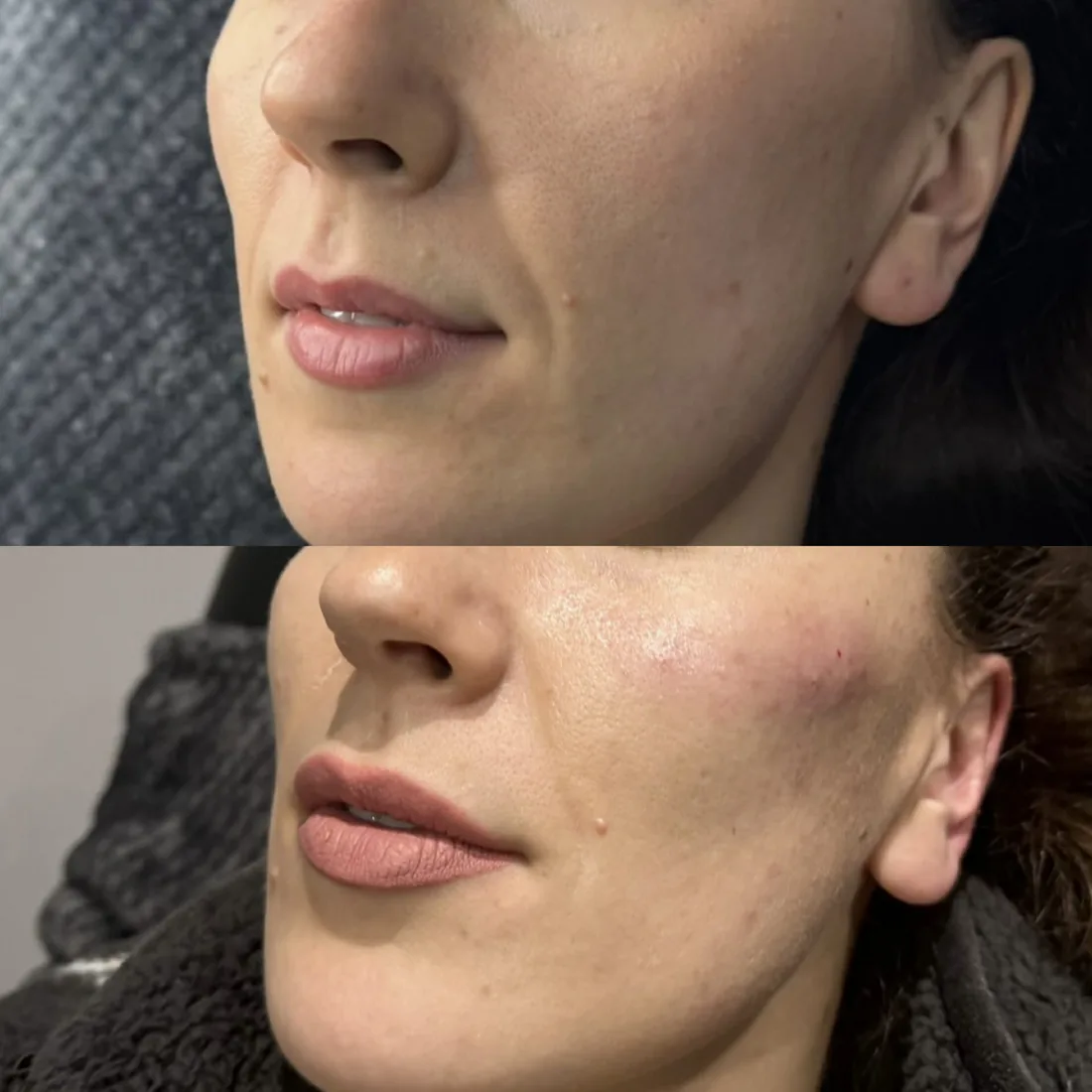 Profile refinement at Refined Medical Aesthetics in Seaton Delaval