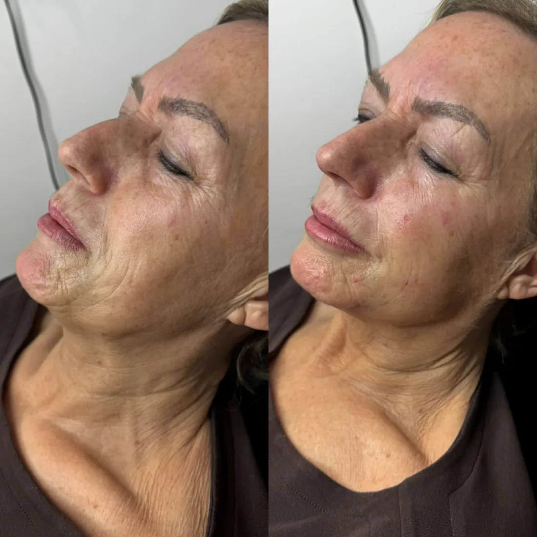 Skin texture and freshness at Refined Medical Aesthetics in Seaton Delaval