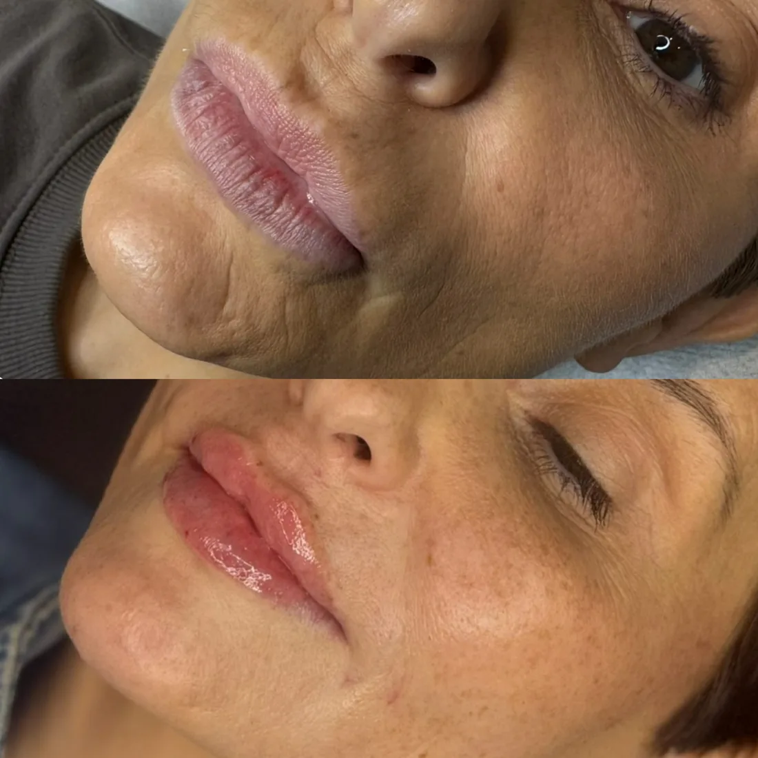 Hydrated lip result at Refined Medical Aesthetics in Seaton Delaval