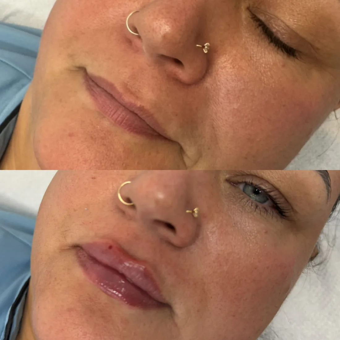 Natural lip balance at Refined Medical Aesthetics in Seaton Delaval