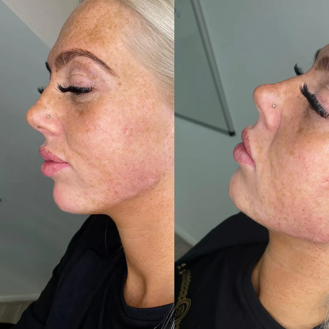 Profile balancing result at Refined Medical Aesthetics in Seaton Delaval