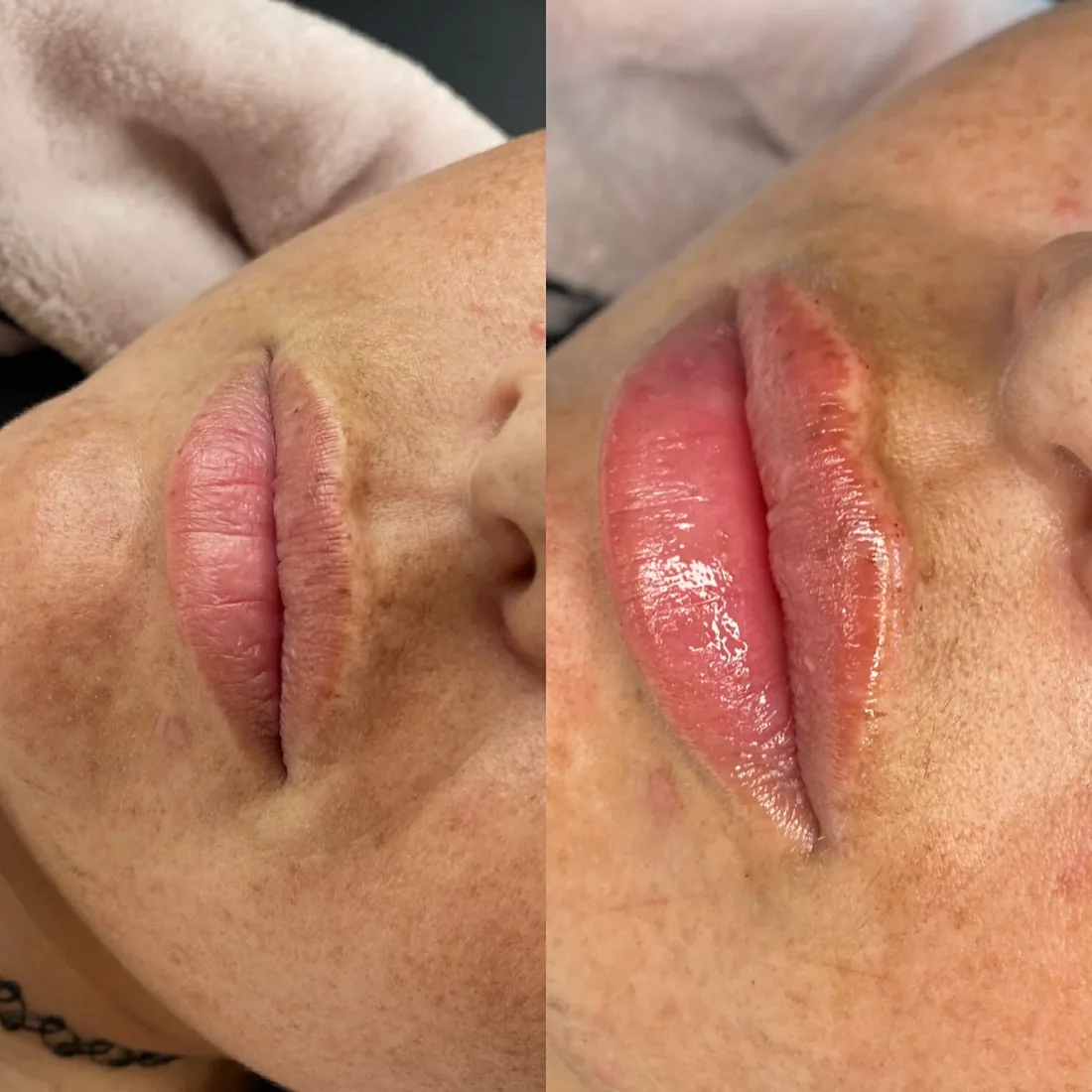 Lip shape and hydration at Refined Medical Aesthetics in Seaton Delaval