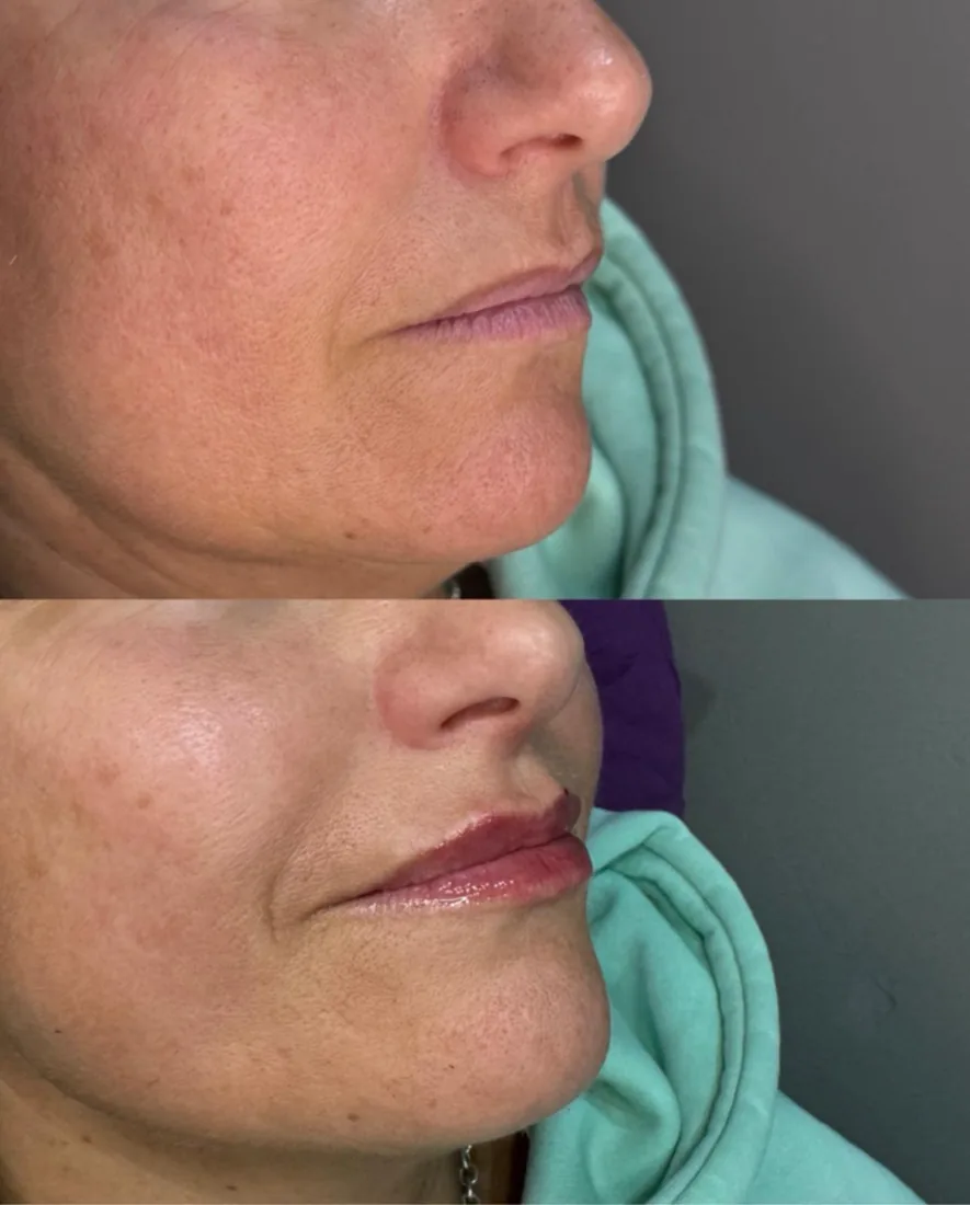 Lower face softening at Refined Medical Aesthetics in Seaton Delaval
