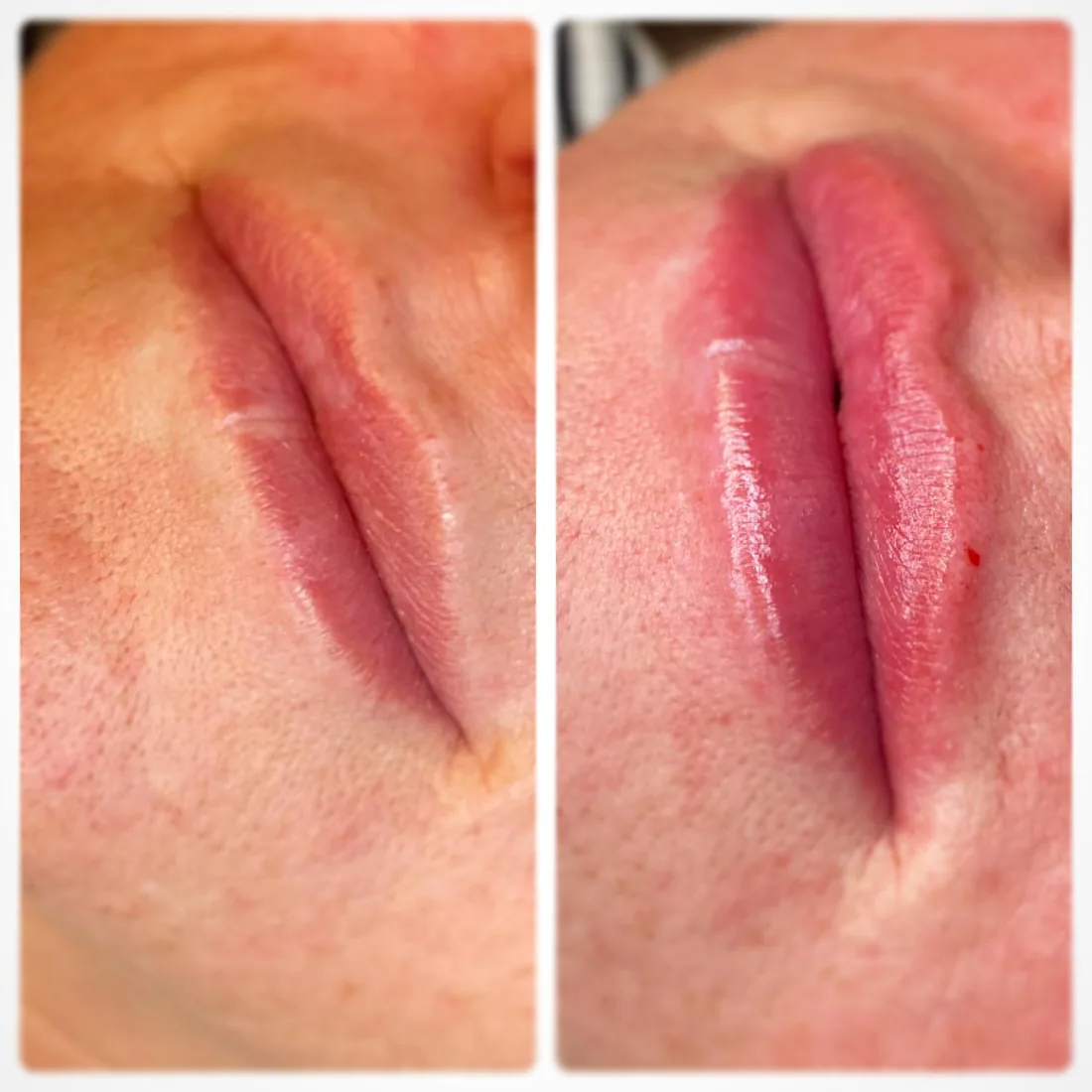 Defined lip border at Refined Medical Aesthetics in Seaton Delaval