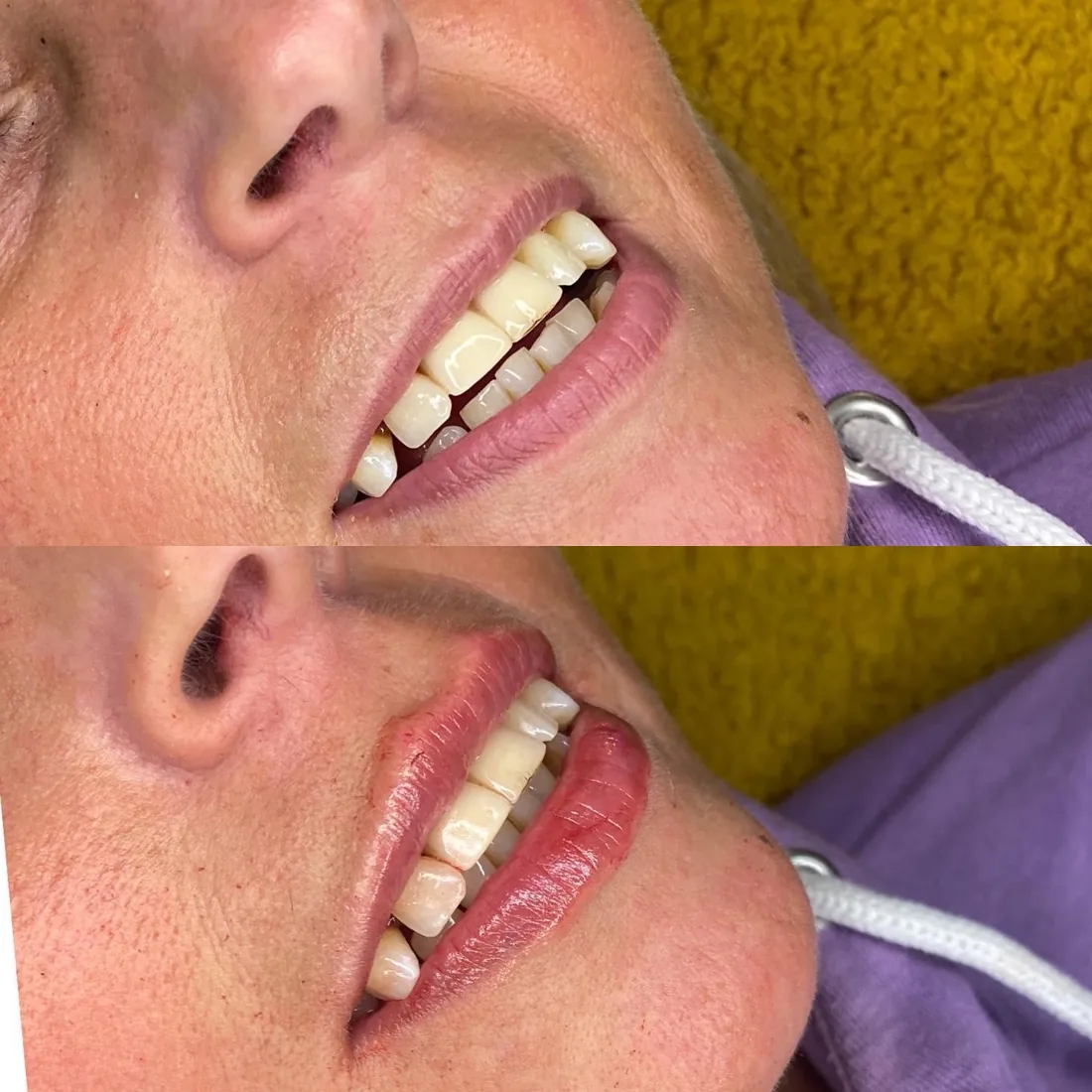 Smile balance at Refined Medical Aesthetics in Seaton Delaval
