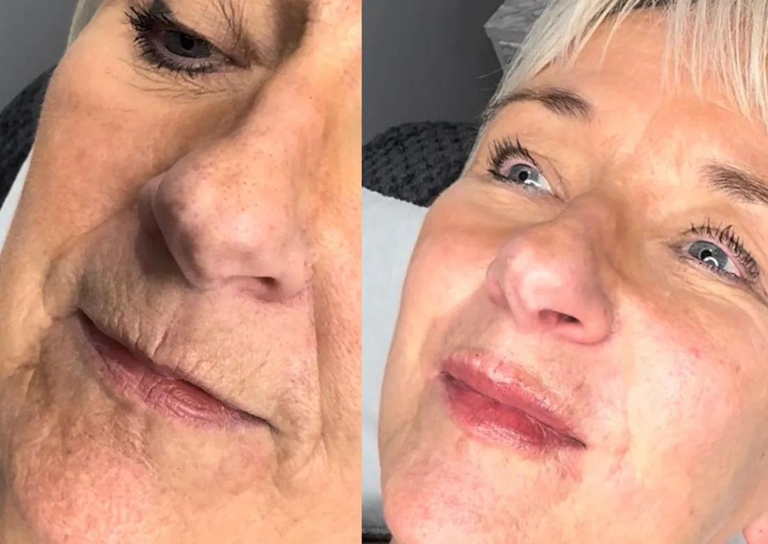 Fresh skin finish at Refined Medical Aesthetics in Seaton Delaval