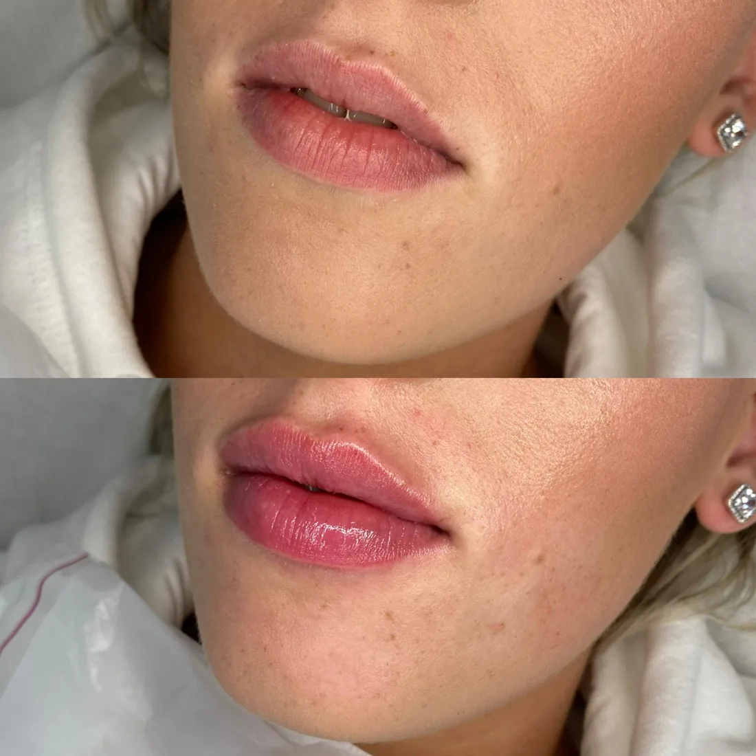 Subtle lip enhancement at Refined Medical Aesthetics in Seaton Delaval