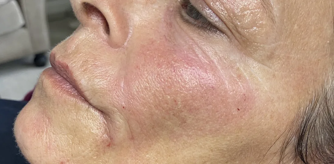 Skin quality result at Refined Medical Aesthetics in Seaton Delaval
