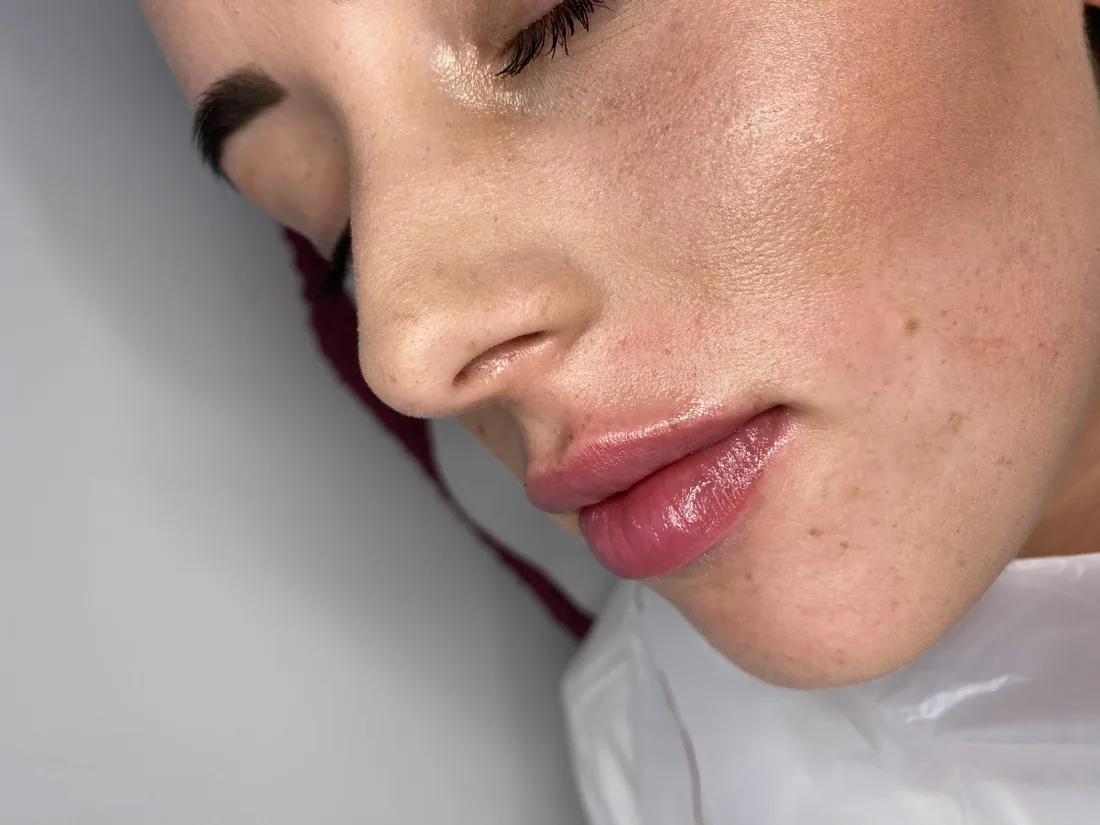Polished lip result at Refined Medical Aesthetics in Seaton Delaval