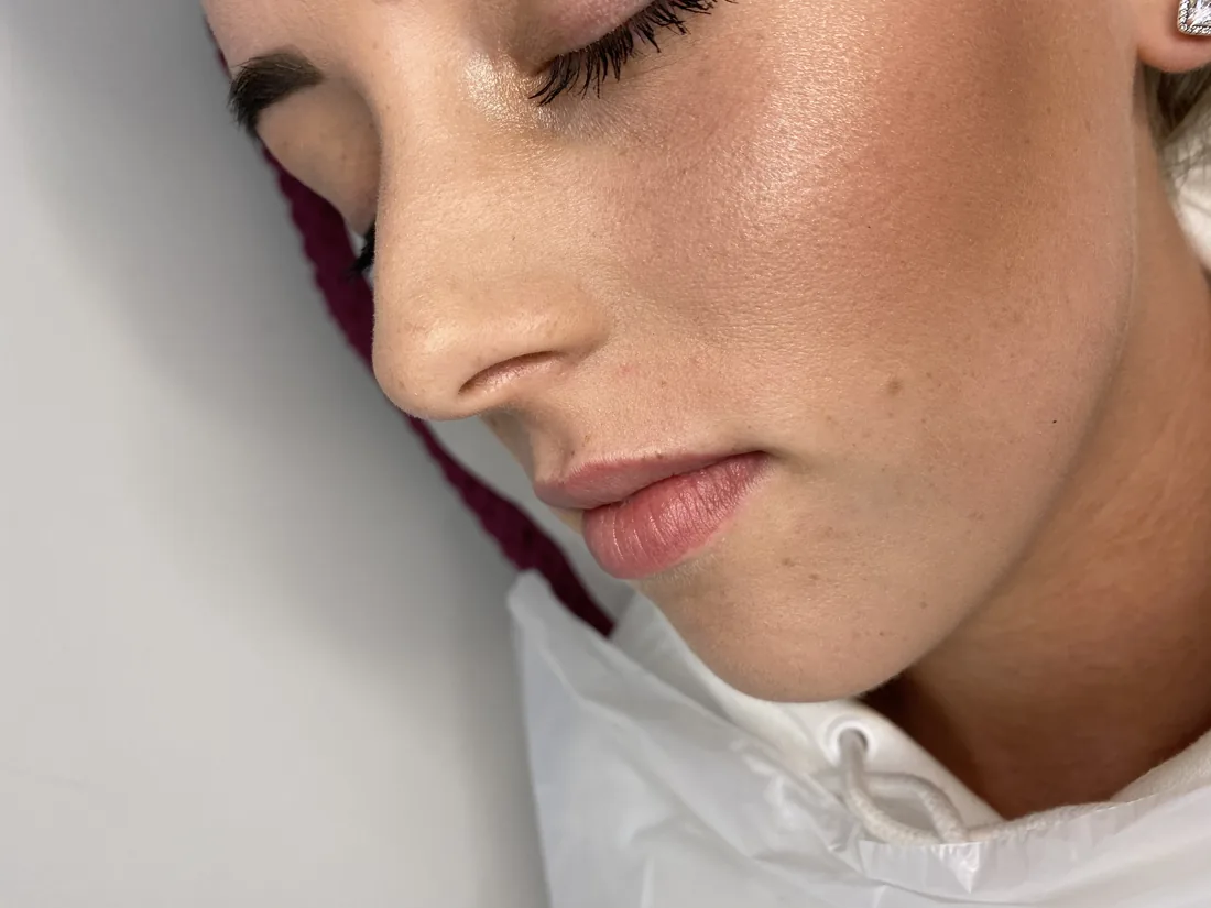 Soft lip profile at Refined Medical Aesthetics in Seaton Delaval