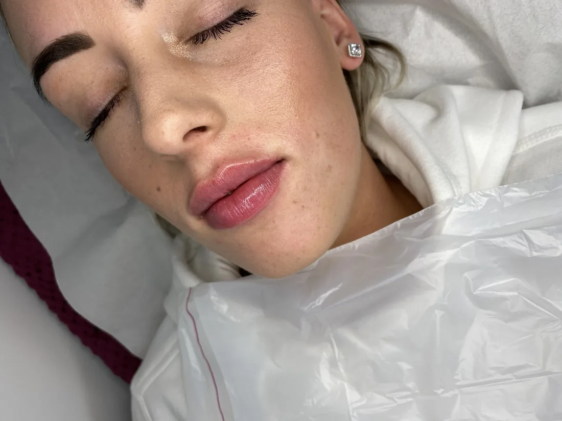 Natural lip finish at Refined Medical Aesthetics in Seaton Delaval