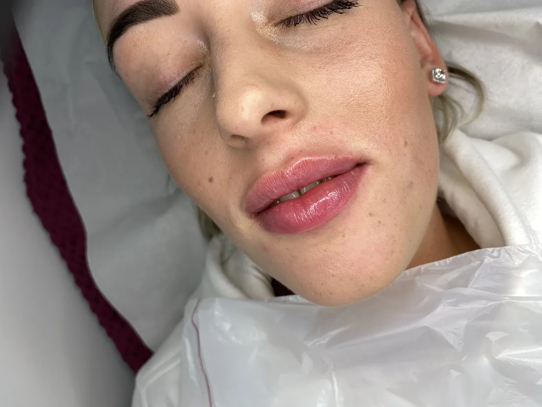 Balanced lip result at Refined Medical Aesthetics in Seaton Delaval