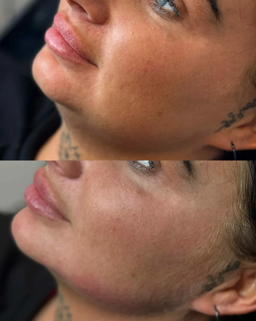 Lower face profile at Refined Medical Aesthetics in Seaton Delaval