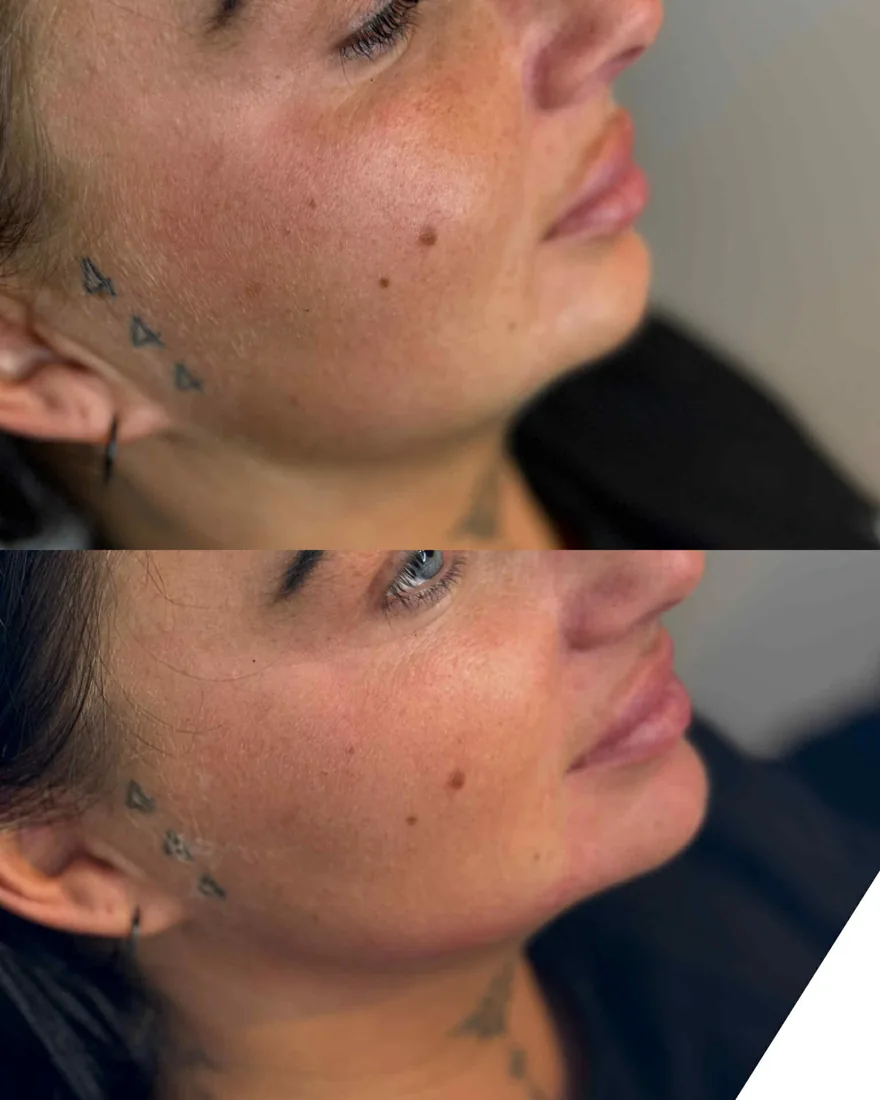 Jawline and profile at Refined Medical Aesthetics in Seaton Delaval